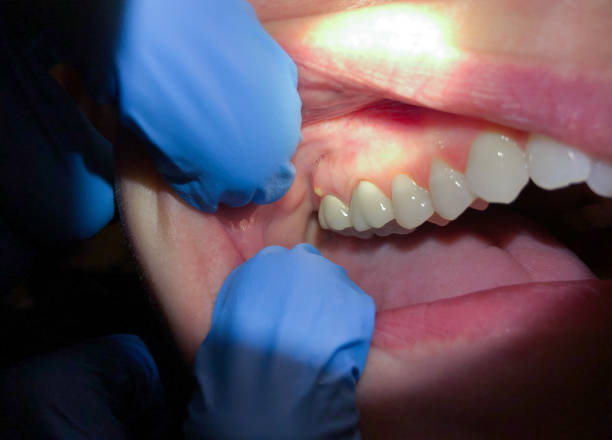 Best Emergency Dentist for Lost Fillings or Crowns in Waihee Waiehu, HI